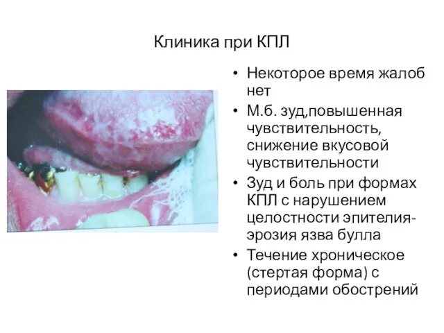 Клиника при КПЛ Некоторое время жалоб нет М.б. зуд,повышенная чувствительность,снижение вкусовой