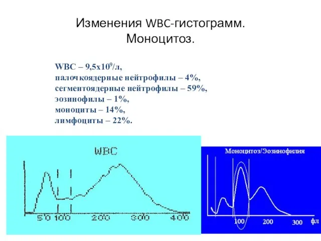 Изменения WBC-гистограмм. Моноцитоз. WBC – 9,5х109/л, палочкоядерные нейтрофилы – 4%, сегментоядерные