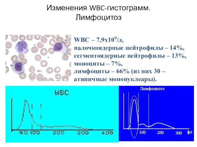 Изменения WBC-гистограмм. Лимфоцитоз WBC – 7,9х109/л, палочкоядерные нейтрофилы – 14%, сегментоядерные