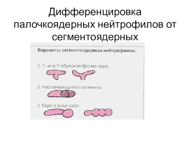 Дифференцировка палочкоядерных нейтрофилов от сегментоядерных