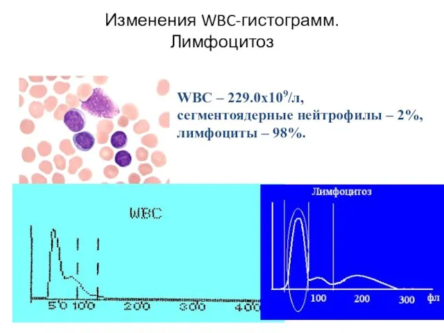 Изменения WBC-гистограмм. Лимфоцитоз WBC – 229.0х109/л, сегментоядерные нейтрофилы – 2%, лимфоциты – 98%.