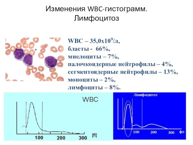 Изменения WBC-гистограмм. Лимфоцитоз WBC – 35,0х109/л, бласты - 66%, миелоциты –