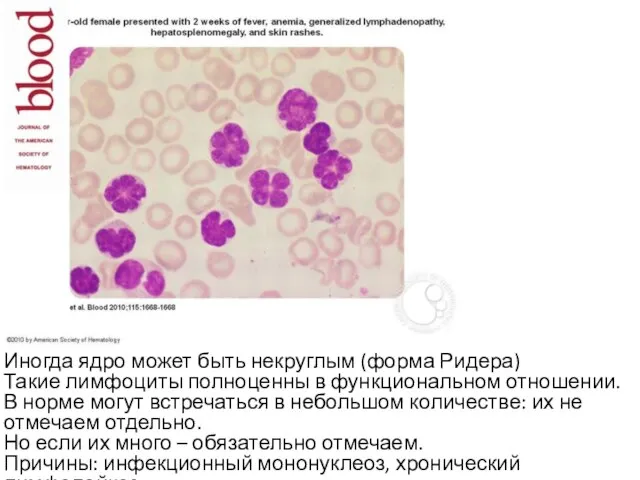 Иногда ядро может быть некруглым (форма Ридера) Такие лимфоциты полноценны в