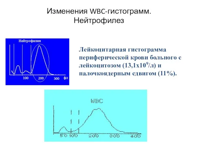 Изменения WBC-гистограмм. Нейтрофилез Лейкоцитарная гистограмма периферической крови больного с лейкоцитозом (13,1х109/л) и палочкоядерным сдвигом (11%).