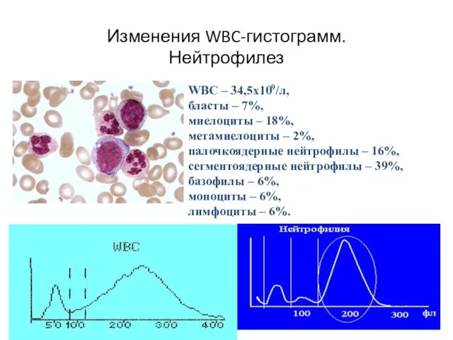 Изменения WBC-гистограмм. Нейтрофилез WBC – 34,5х109/л, бласты – 7%, миелоциты –