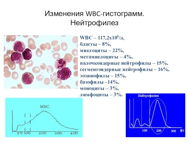 Изменения WBC-гистограмм. Нейтрофилез WBC – 117,2х109/л, бласты – 8%, миелоциты –