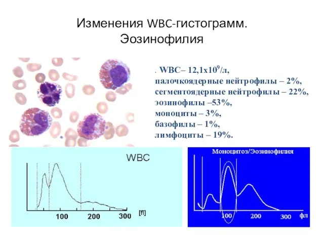 Изменения WBC-гистограмм. Эозинофилия . WBC– 12,1х109/л, палочкоядерные нейтрофилы – 2%, сегментоядерные