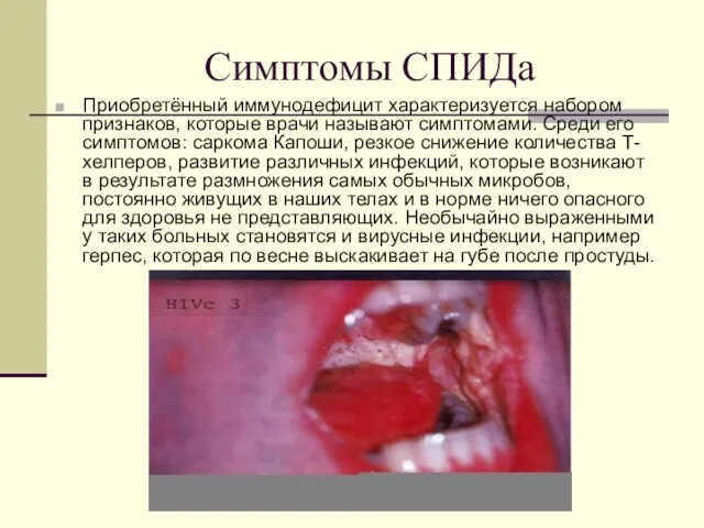 Симптомы СПИДа Приобретённый иммунодефицит характеризуется набором признаков, которые врачи называют симптомами.