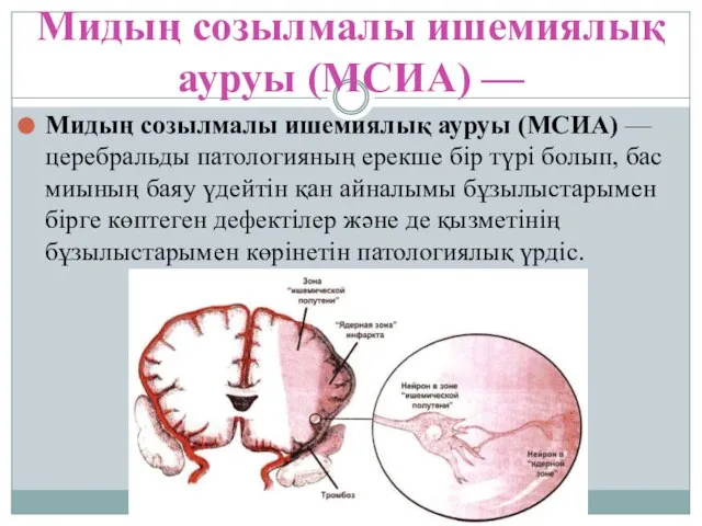 Мидың созылмалы ишемиялық ауруы (МСИА) — Мидың созылмалы ишемиялық ауруы (МСИА)