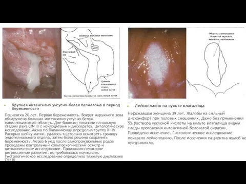 Крупная интенсивно уксусно-белая папиллома в период беременности Пациентка 20 лет. Первая