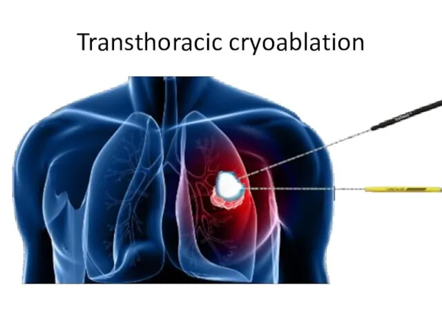 Transthoracic cryoablation