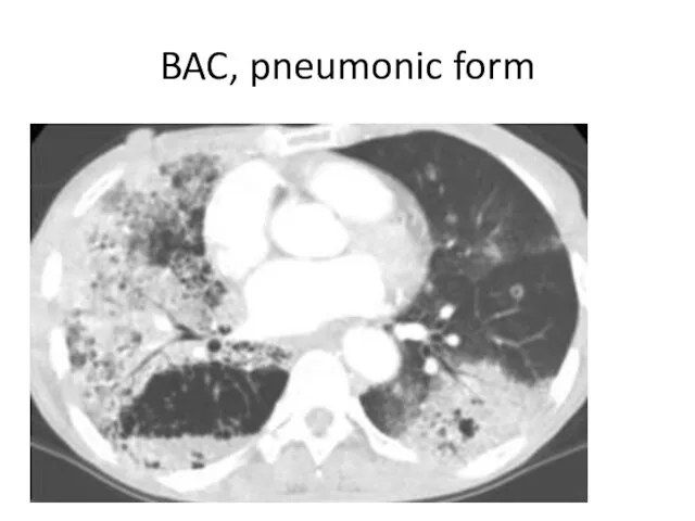 BAC, pneumonic form