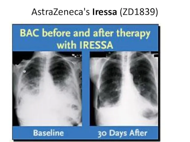 AstraZeneca's Iressa (ZD1839)