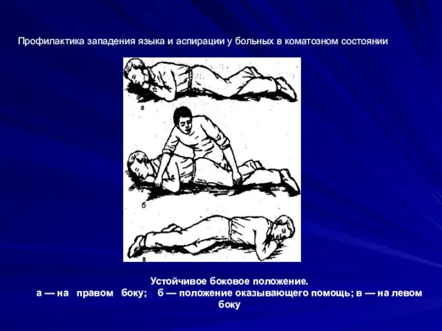 Профилактика западения языка и аспирации у больных в коматозном состоянии Устойчивое