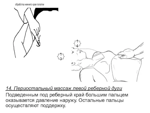 14. Периостальный массаж левой реберной дуги Подведенным под реберный край большим