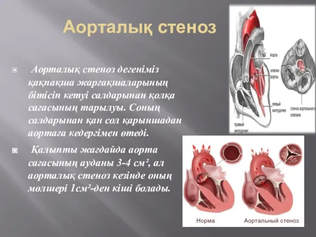 Аорталық стеноз Аорталық стеноз дегеніміз қақпақша жарғақшаларының бітісіп кетуі салдарынан қолқа
