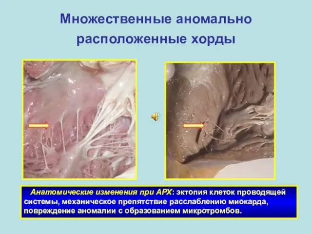 Множественные аномально расположенные хорды Анатомические изменения при АРХ: эктопия клеток проводящей