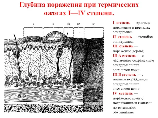 Глубина поражения при термических ожогах I—IV степени. I степень — эритема