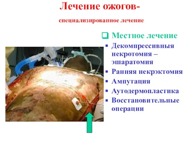 Лечение ожогов- специализированное лечение Местное лечение Декомпрессивныя некротомия – эшаратомия Ранняя некрэктомия Ампутация Аутодермопластика Восстановительные операции