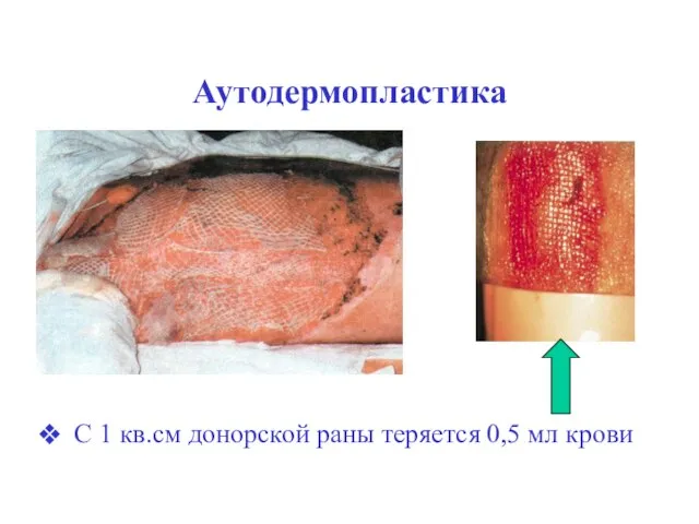 Аутодермопластика С 1 кв.см донорской раны теряется 0,5 мл крови