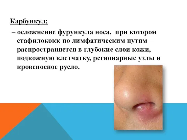 Карбункул: – осложнение фурункула носа, при котором стафилококк по лимфатическим путям