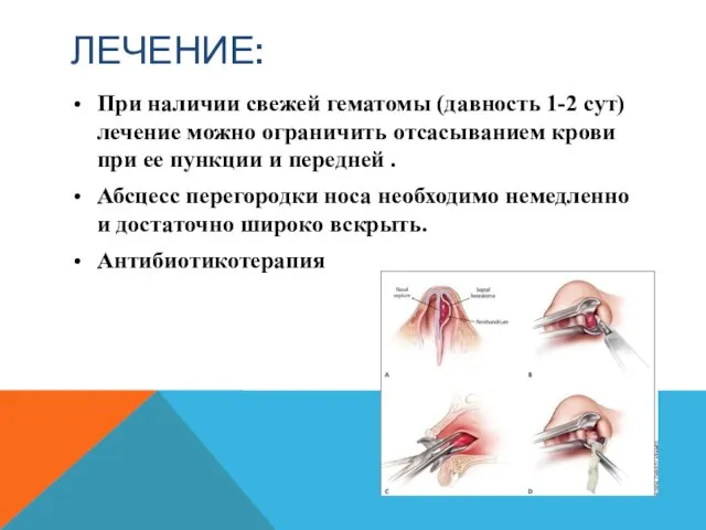 ЛЕЧЕНИЕ: При наличии свежей гематомы (давность 1-2 сут) лечение можно ограничить