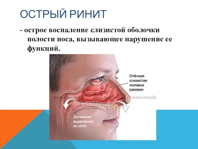 ОСТРЫЙ РИНИТ - острое воспаление слизистой оболочки полости носа, вызывающее нарушение ее функций.