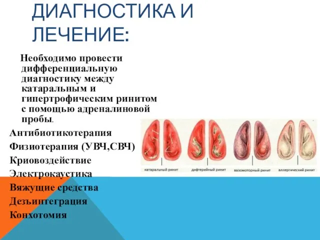 ДИАГНОСТИКА И ЛЕЧЕНИЕ: Необходимо провести дифференциальную диагностику между катаральным и гипертрофическим