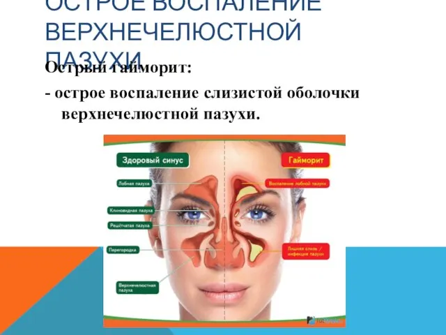 ОСТРОЕ ВОСПАЛЕНИЕ ВЕРХНЕЧЕЛЮСТНОЙ ПАЗУХИ Острый гайморит: - острое воспаление слизистой оболочки верхнечелюстной пазухи.