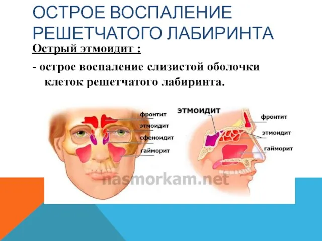 ОСТРОЕ ВОСПАЛЕНИЕ РЕШЕТЧАТОГО ЛАБИРИНТА Острый этмоидит : - острое воспаление слизистой оболочки клеток решетчатого лабиринта.