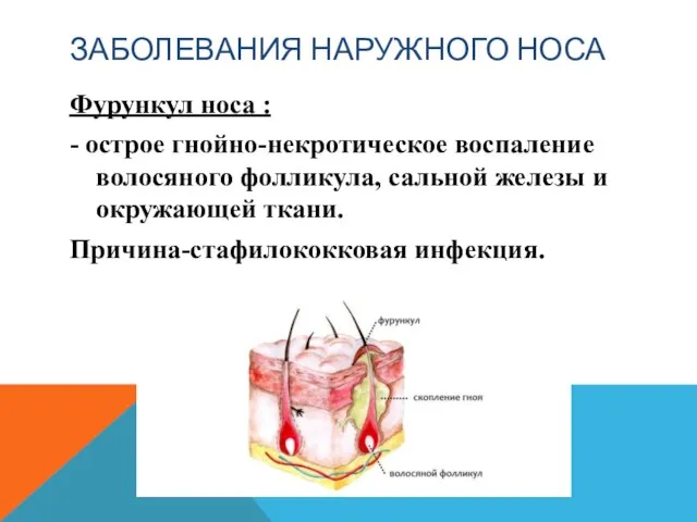 ЗАБОЛЕВАНИЯ НАРУЖНОГО НОСА Фурункул носа : - острое гнойно-некротическое воспаление волосяного