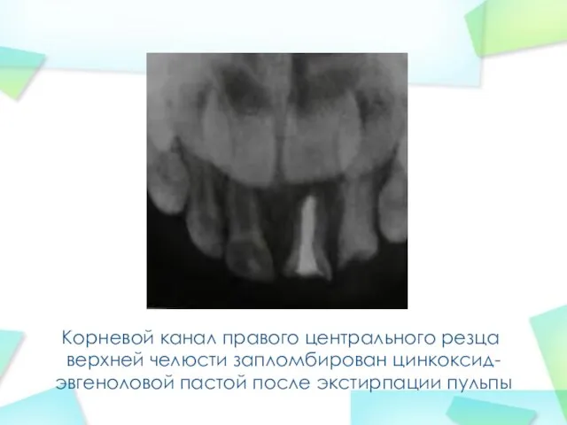Корневой канал правого центрального резца верхней челюсти запломбирован цинкоксид-эвгеноловой пастой после экстирпации пульпы