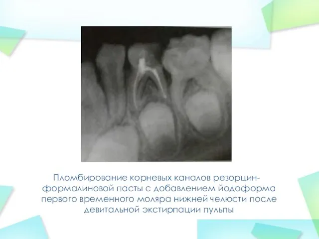 Пломбирование корневых каналов резорцин-формалиновой пасты с добавлением йодоформа первого временного моляра