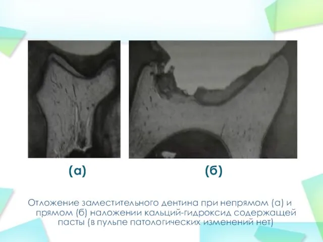 Отложение заместительного дентина при непрямом (а) и прямом (б) наложении кальций-гидроксид
