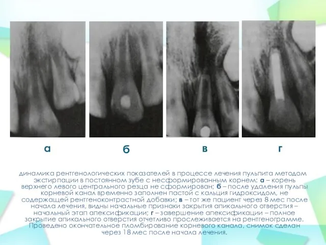 динамика рентгенологических показателей в процессе лечения пульпита методом экстирпации в постоянном