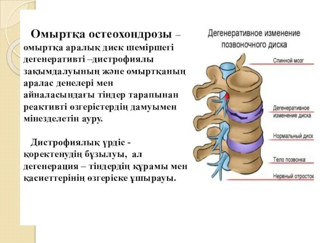 Омыртқа остеохондрозы – омыртқа аралық диск шеміршегі дегенеративті –дистрофиялы зақымдалуының жəне