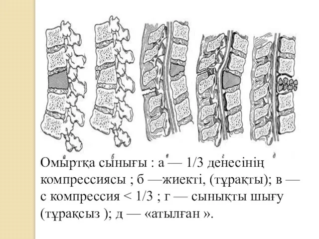 Омыртқа сынығы : а — 1/3 денесінің компрессиясы ; б —жиекті, (тұрақты); в — с компрессия