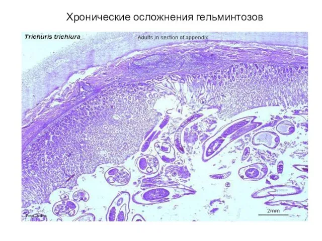 Хронические осложнения гельминтозов