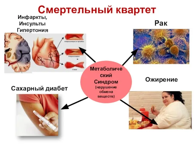 Смертельный квартет Рак Сахарный диабет Инфаркты, Инсульты Гипертония Ожирение Метаболический Синдром (нарушение обмена веществ)