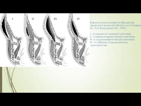 Варианты расположения абсцессов (флегмон) височной области (из: Соловьев М.М., О.П. Большаков