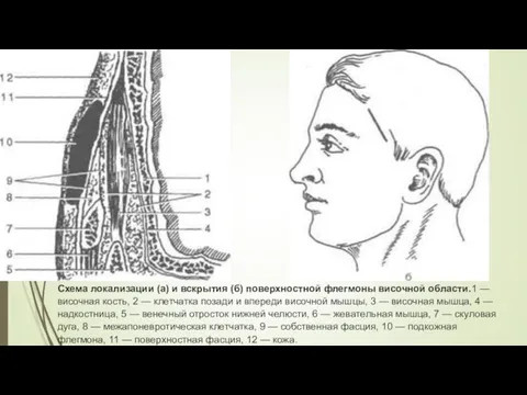 Схема локализации (а) и вскрытия (б) поверхностной флегмоны височной области.1 —