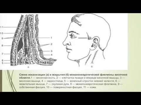 Схема локализации (а) и вскрытия (б) межапоневротической флегмоны височной области.1 —