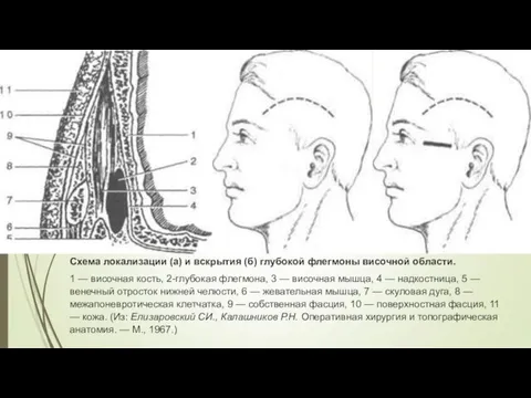 Схема локализации (а) и вскрытия (б) глубокой флегмоны височной области. 1