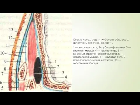 Схема локализации глубокого абсцесса, флегмоны височной области. 1 — височная кость,