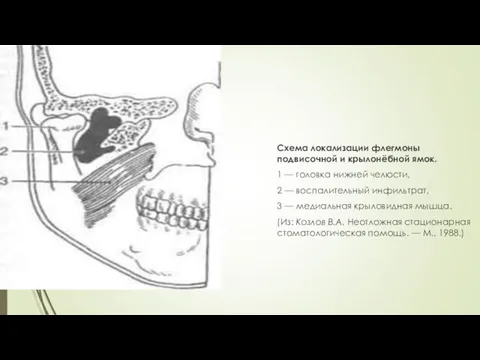 Схема локализации флегмоны подвисочной и крылонёбной ямок. 1 — головка нижней