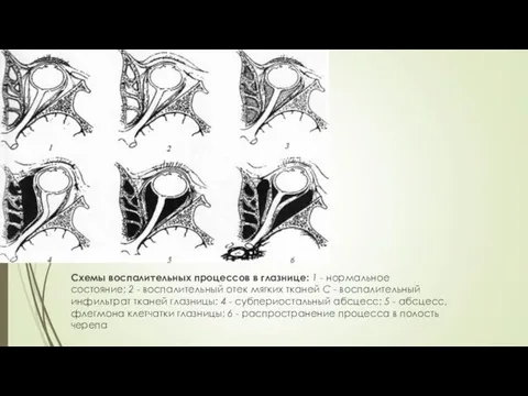 Схемы воспалительных процессов в глазнице: 1 - нормальное состояние; 2 -