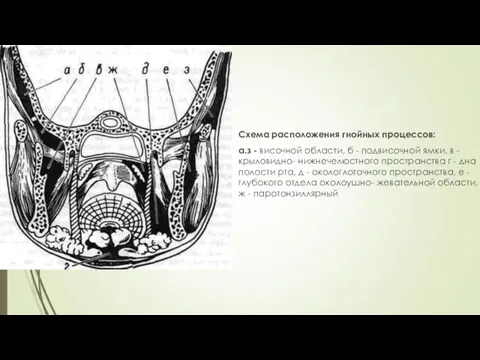 Схема расположения гнойных процессов: а.з - височной области, б - подвисочной