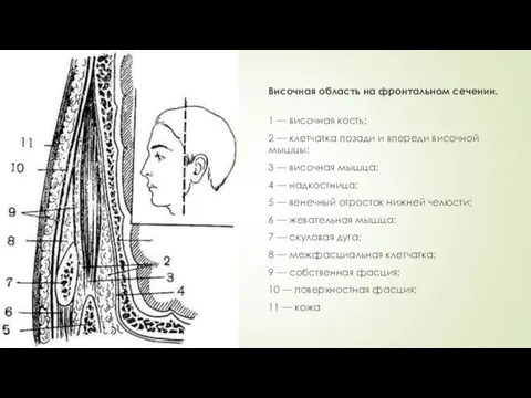 Височная область на фронтальном сечении. 1 — височная кость; 2 —