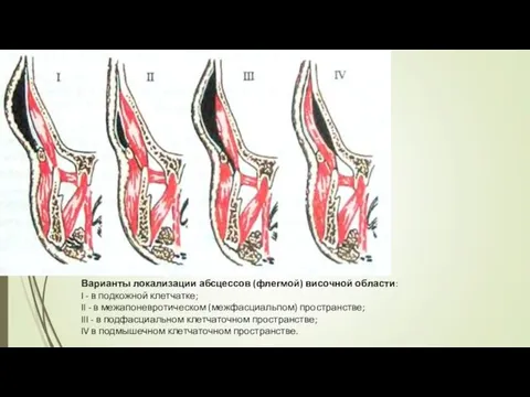 Варианты локализации абсцессов (флегмой) височной области: I - в подкожной клетчатке;
