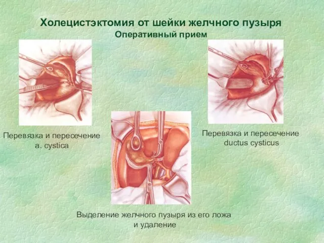 Холецистэктомия от шейки желчного пузыря Оперативный прием Перевязка и пересечение a.
